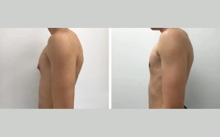 Step-by-Step Guide to Booking Your Gynecomastia Surgery in Dubai