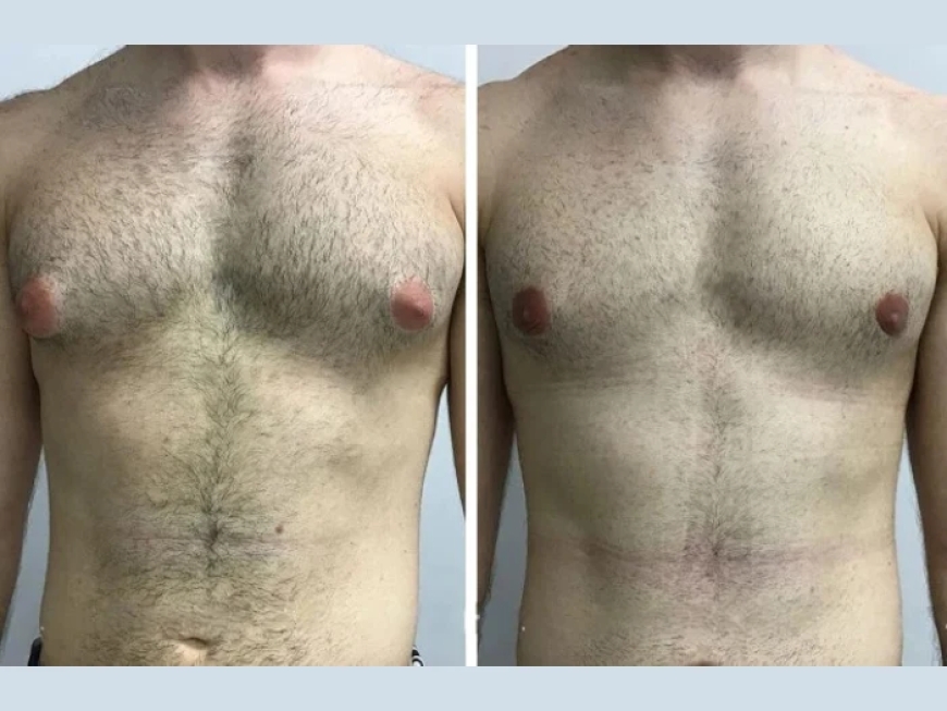 Finding the Best Surgeons for Gynecomastia in Dubai