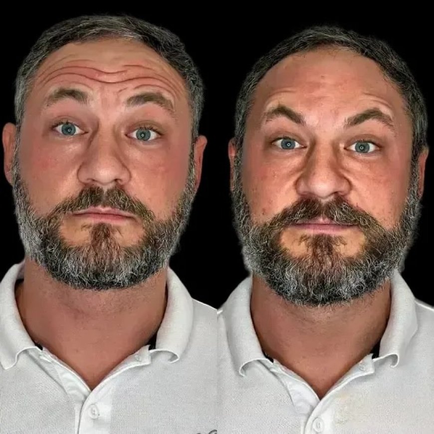 Ignite Skin Evolution through Profhilo in Dubai