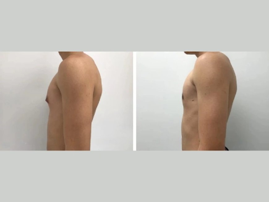 Step-by-Step Guide to Booking Your Gynecomastia Surgery in Dubai