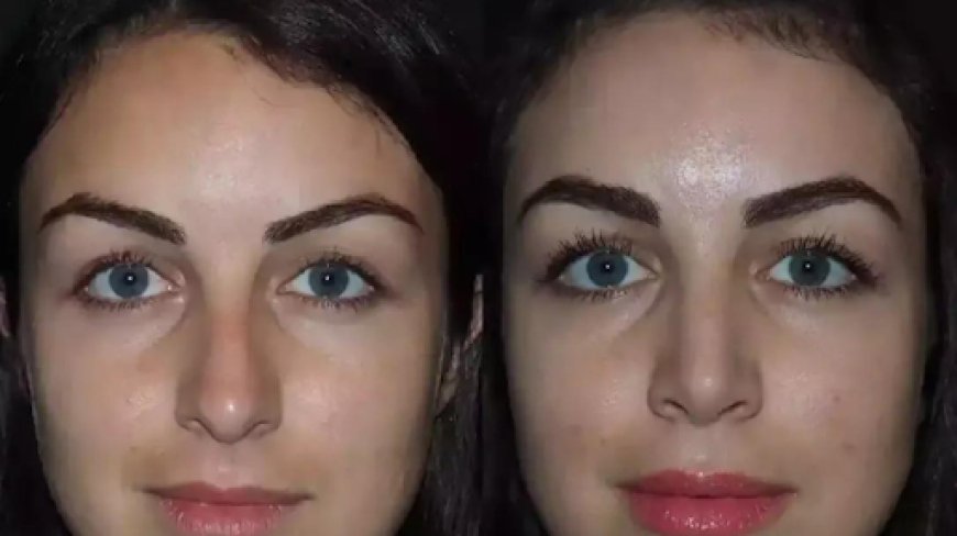 Natural-Looking Results from Rhinoplasty in Dubai