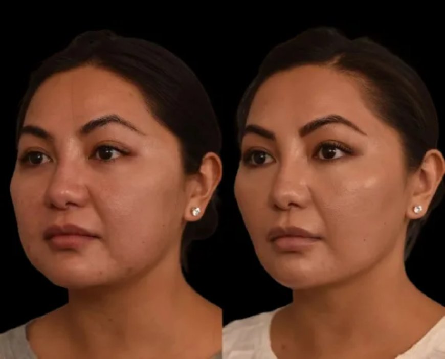 Cost vs Results: Is Double chin removal in Dubai Worth It?