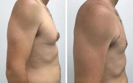 What to Expect from the Best Gynecomastia Surgeons in dubai
