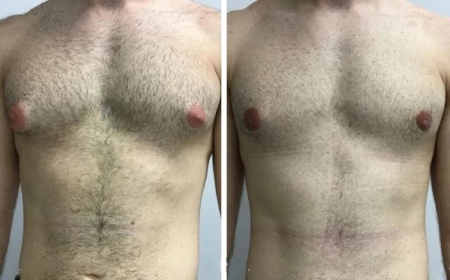 Combining Liposuction with Gynecomastia Surgery in Dubai – Is It Right for You?