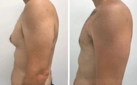 What Sets the Best Gynecomastia Surgeons in Dubai Apart in Terms of Expertise