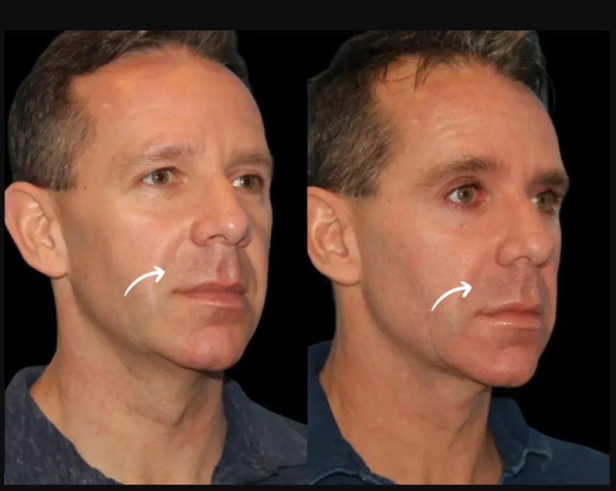 How to Choose the Best Aesthetic Clinic in Dubai for Sculptra Fillers