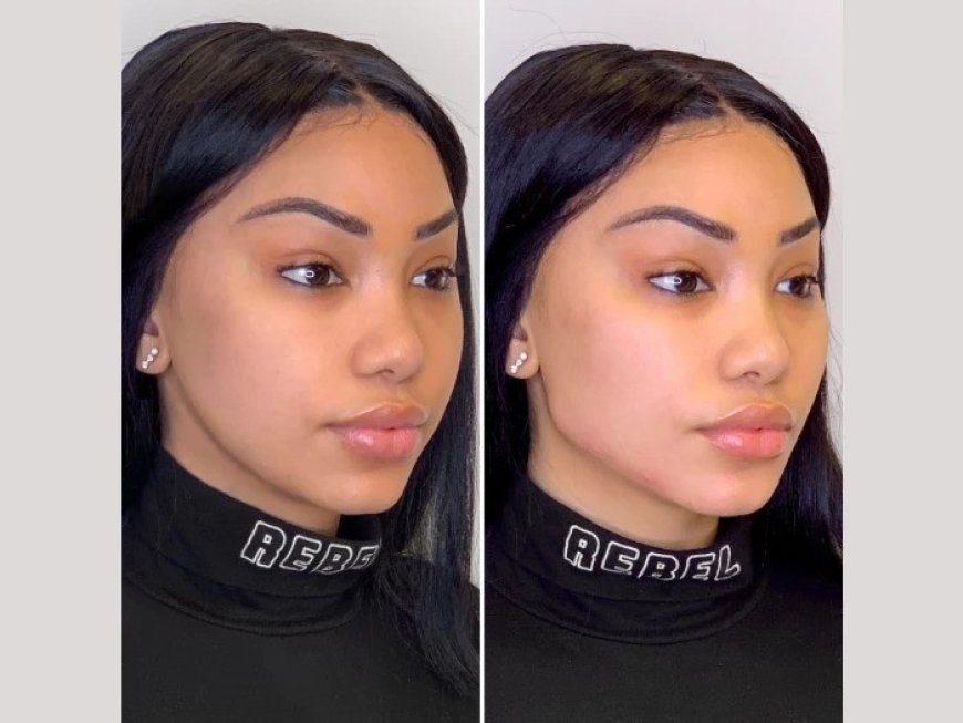 Best Plastic Surgeons in Dubai Offering Thread Lifts for Skin Tightening After Weight Loss