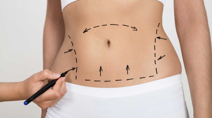 Is Liposuction Dubai Permanent? Maintaining Your Results Long-Term