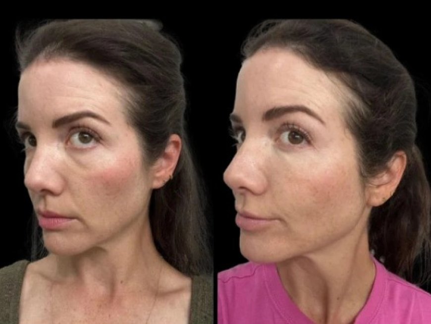 How the Best Doctors in Dubai Identify the Root Causes of Dark Circles treatment treal