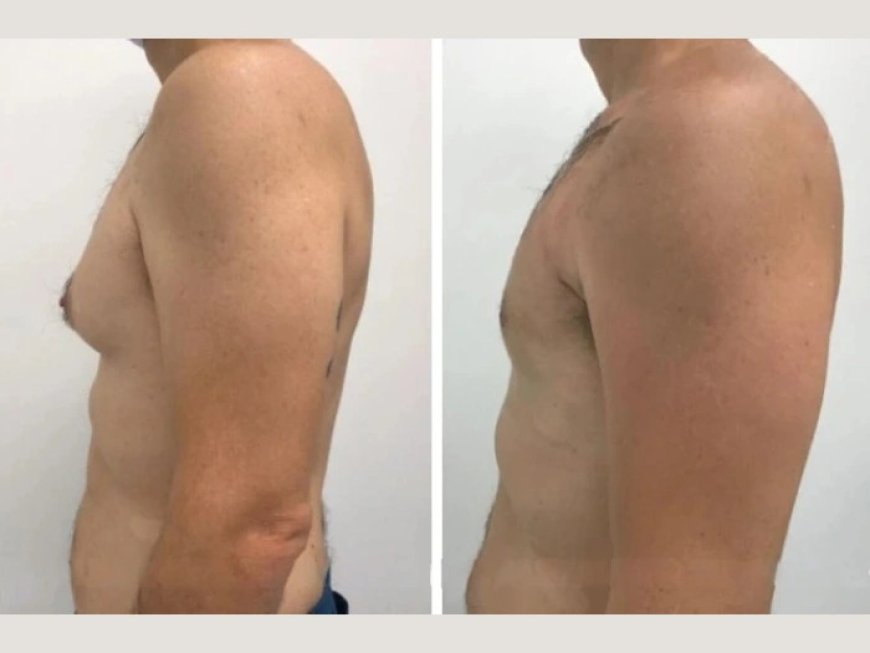 What Sets the Best Gynecomastia Surgeons in Dubai Apart in Terms of Expertise